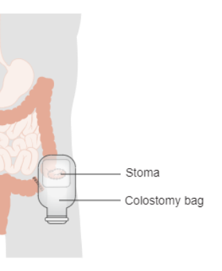 COLOSTOMY BAG