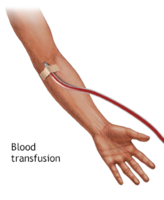 blood transfusion