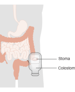 Closed Chinese Colostomy Bags